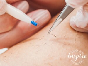 Epilation par éléctrolyse et haute fréquence